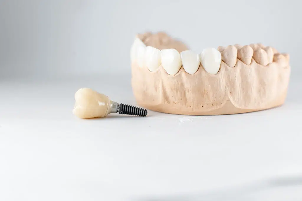 2model of artificial jaw and dental implant 2025 03 14 12 51 35 utc