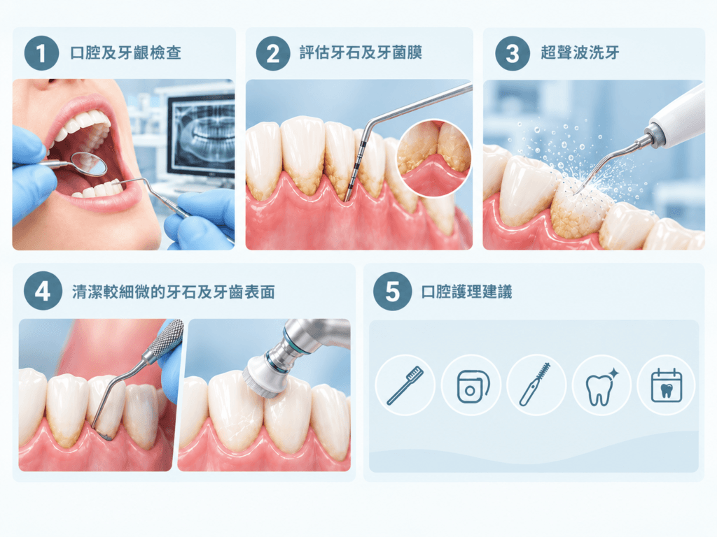 洗牙及牙齒拋光 3 JLDC tooth washing step